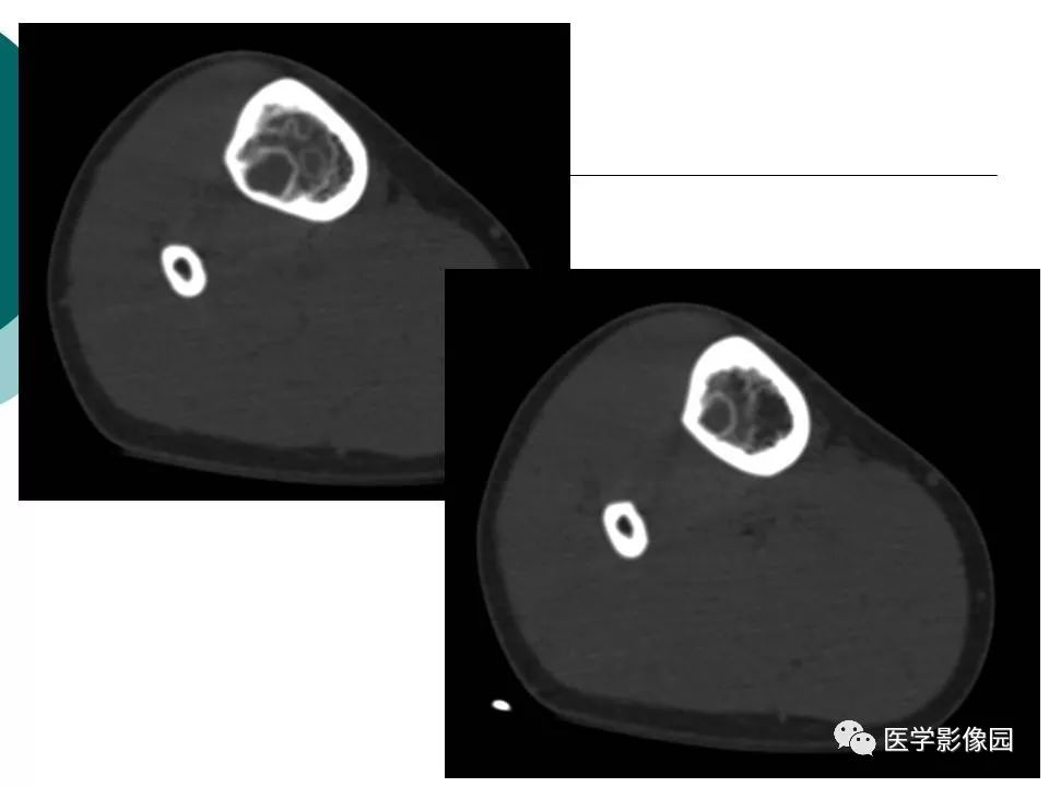 【病例】胫骨非骨化性纤维瘤1例CT及MR