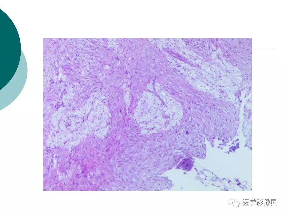 【病例】胫骨非骨化性纤维瘤1例CT及MR