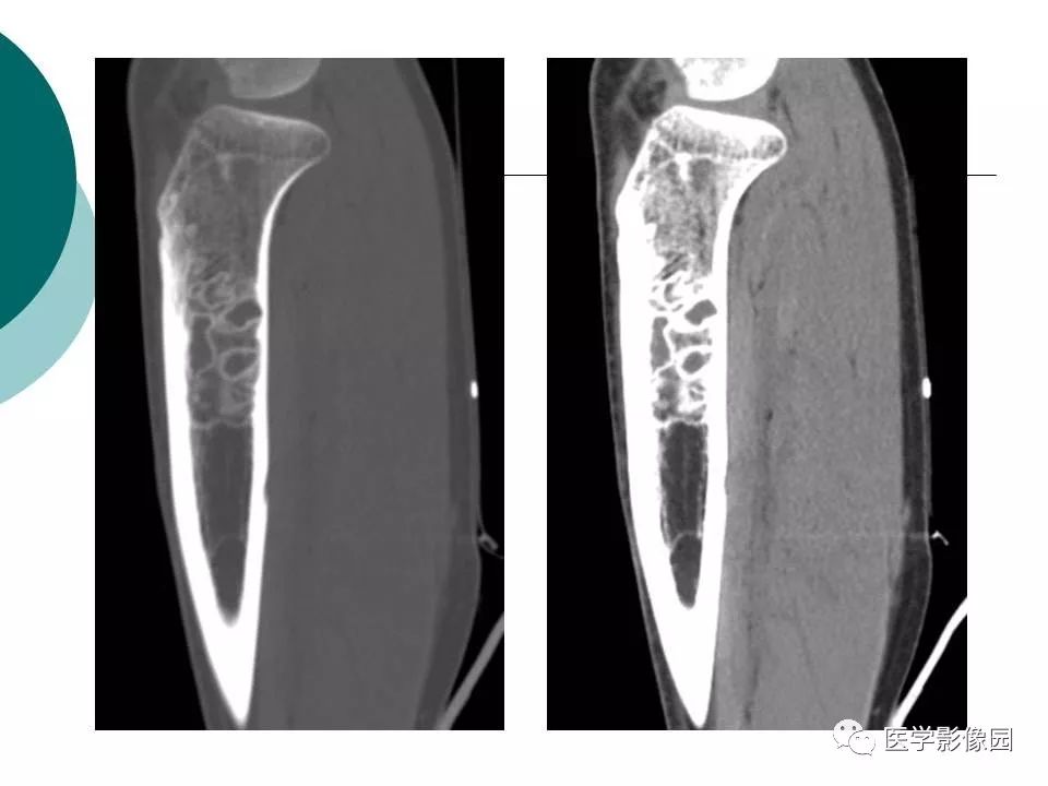 【病例】胫骨非骨化性纤维瘤1例CT及MR