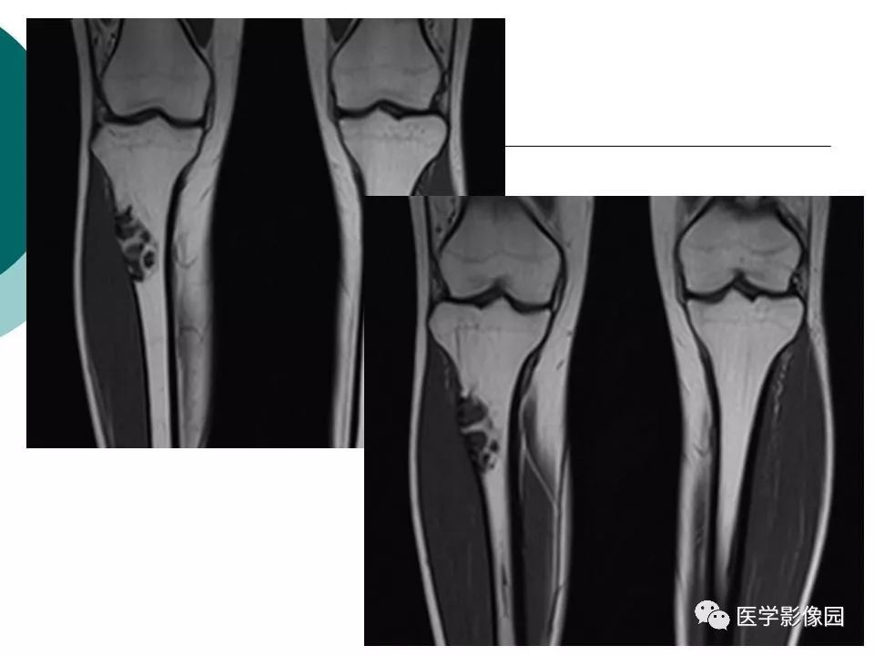 【病例】胫骨非骨化性纤维瘤1例CT及MR