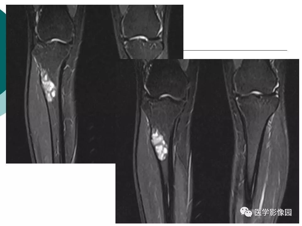 【病例】胫骨非骨化性纤维瘤1例CT及MR