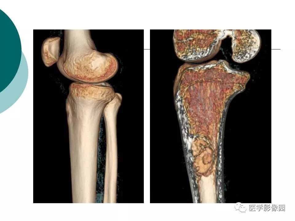 【病例】胫骨非骨化性纤维瘤1例CT及MR