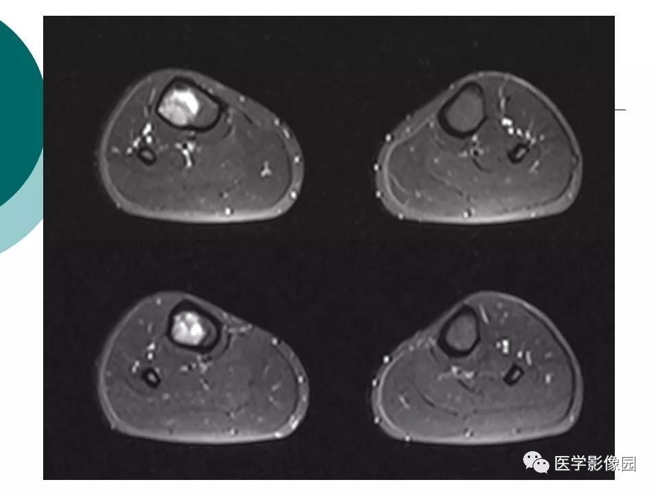 【病例】胫骨非骨化性纤维瘤1例CT及MR