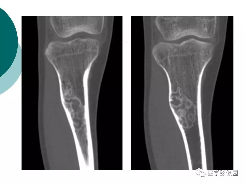 【病例】胫骨非骨化性纤维瘤1例CT及MR