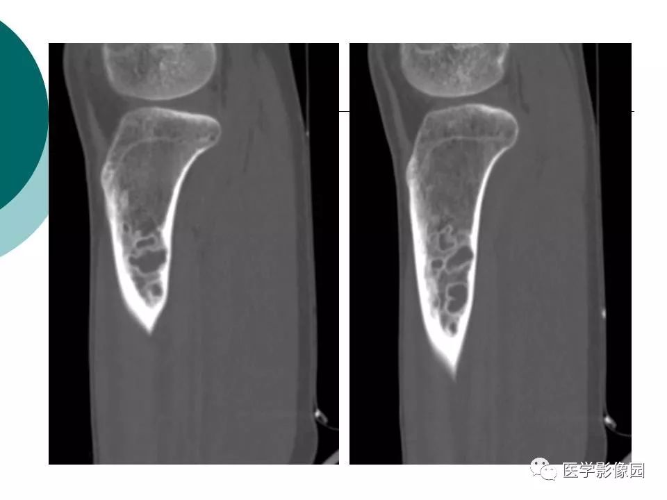 【病例】胫骨非骨化性纤维瘤1例CT及MR