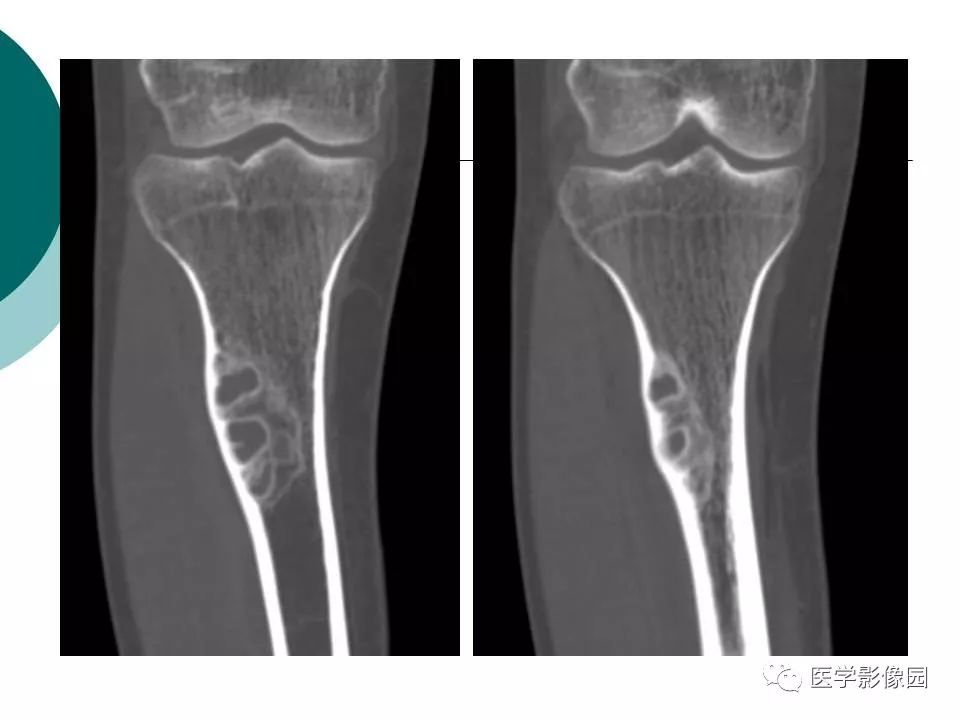 【病例】胫骨非骨化性纤维瘤1例CT及MR
