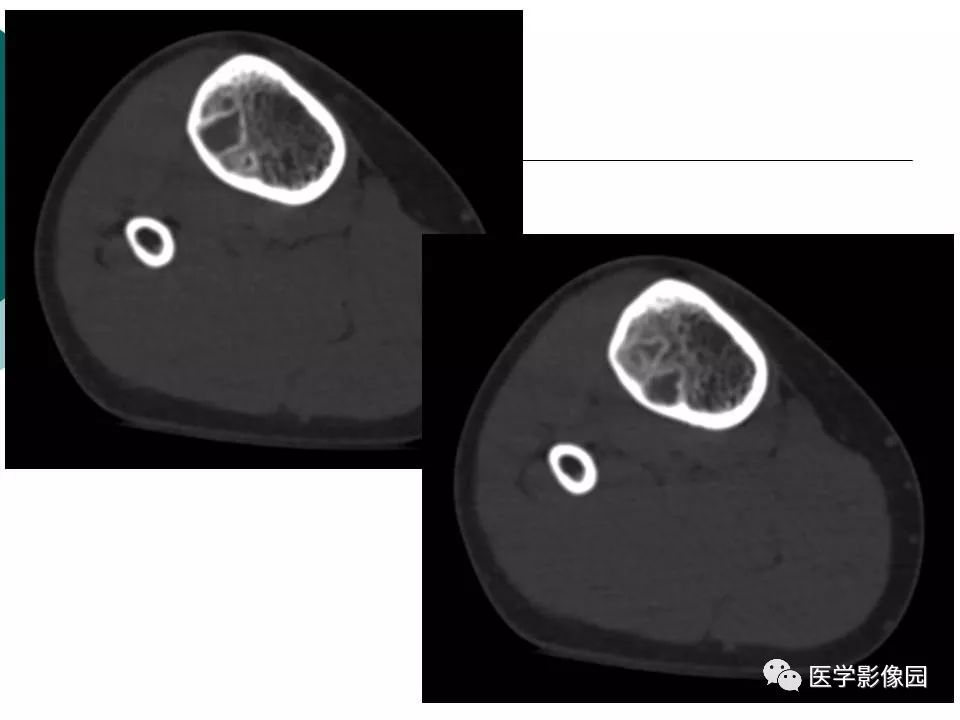 【病例】胫骨非骨化性纤维瘤1例CT及MR