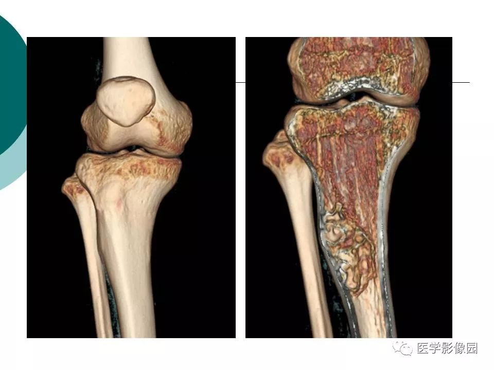 【病例】胫骨非骨化性纤维瘤1例CT及MR