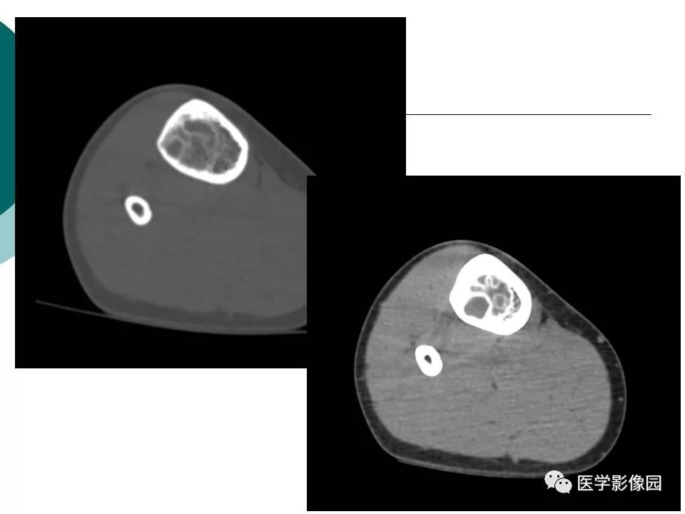【病例】胫骨非骨化性纤维瘤1例CT及MR