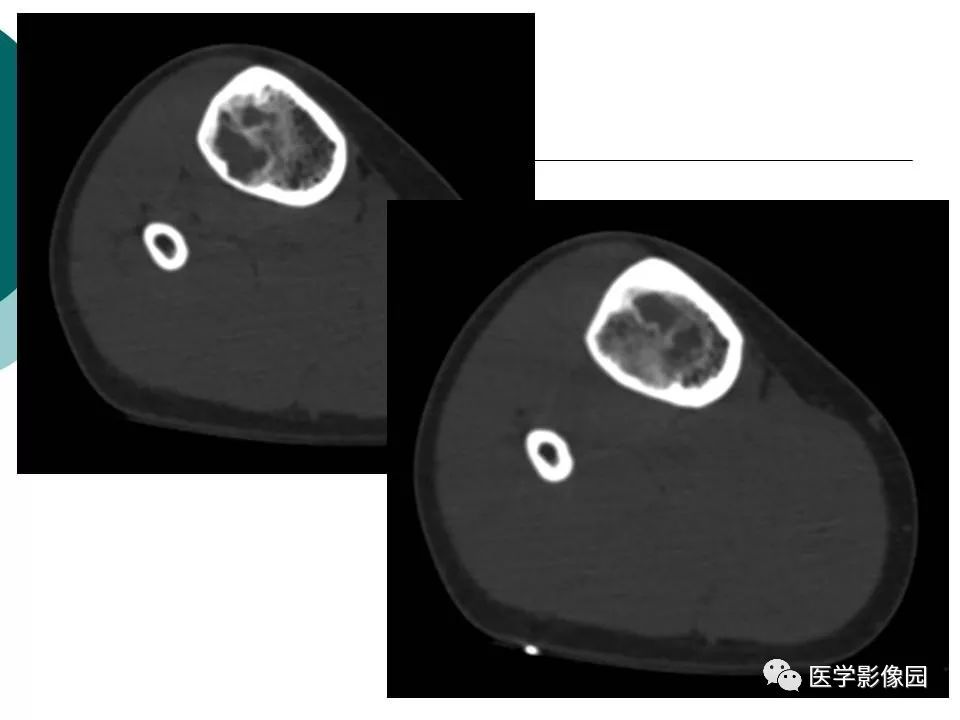 【病例】胫骨非骨化性纤维瘤1例CT及MR