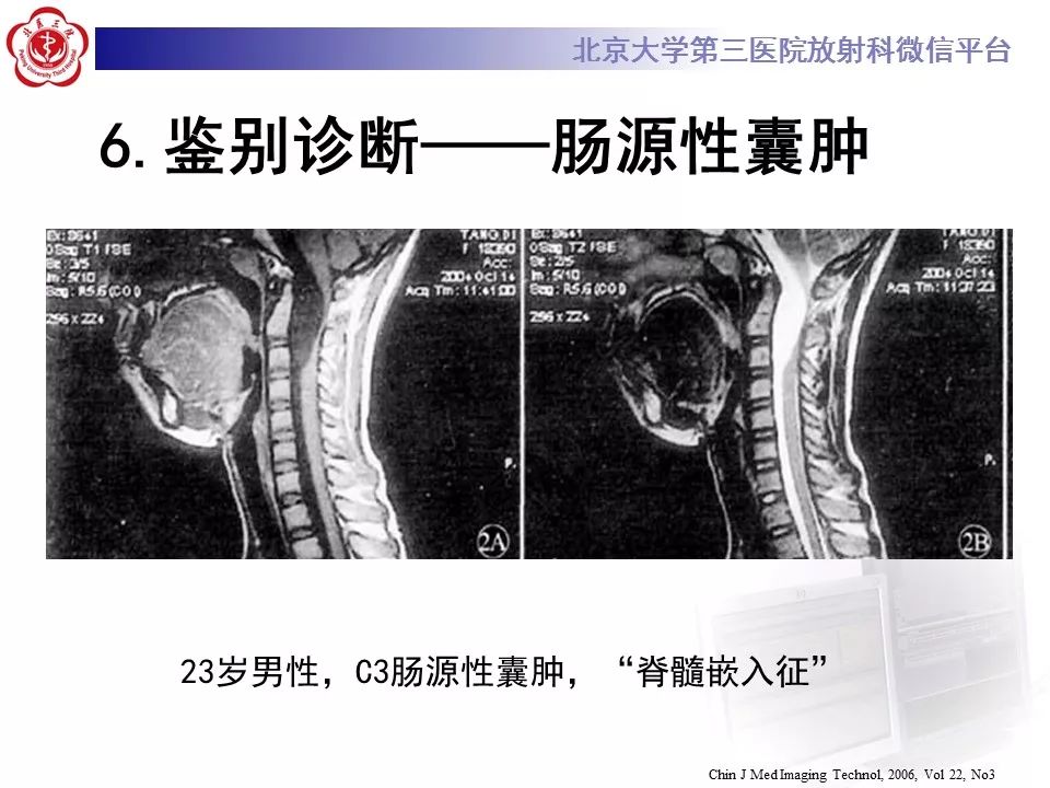 【病例】椎管内髓外硬膜下畸胎瘤1例