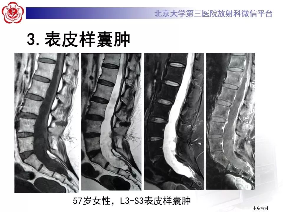 【病例】椎管内髓外硬膜下畸胎瘤1例