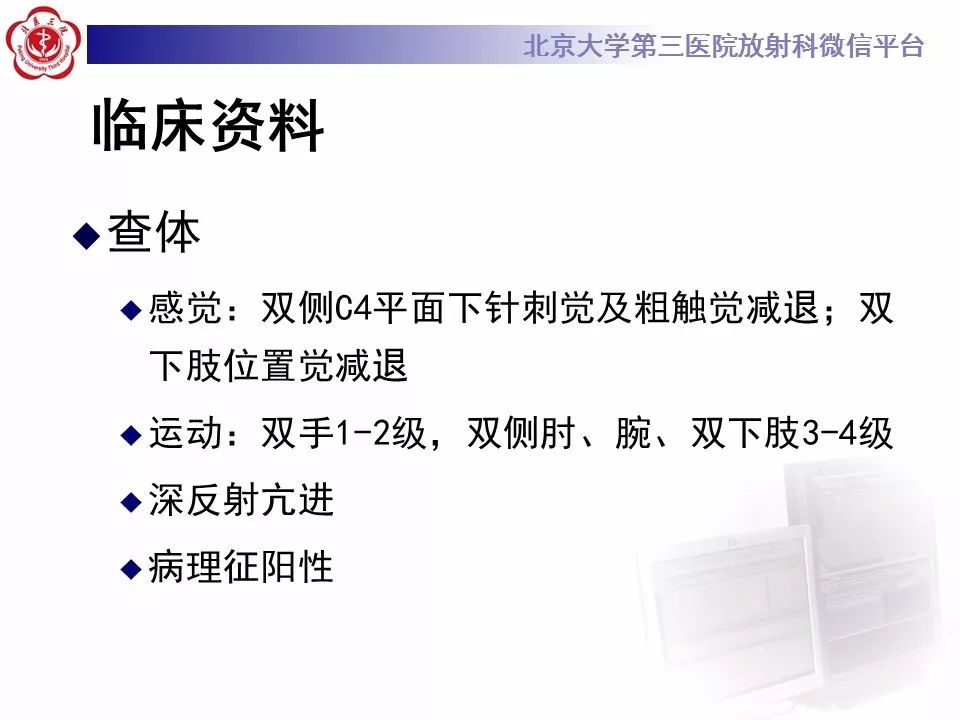 【病例】椎管内髓外硬膜下畸胎瘤1例