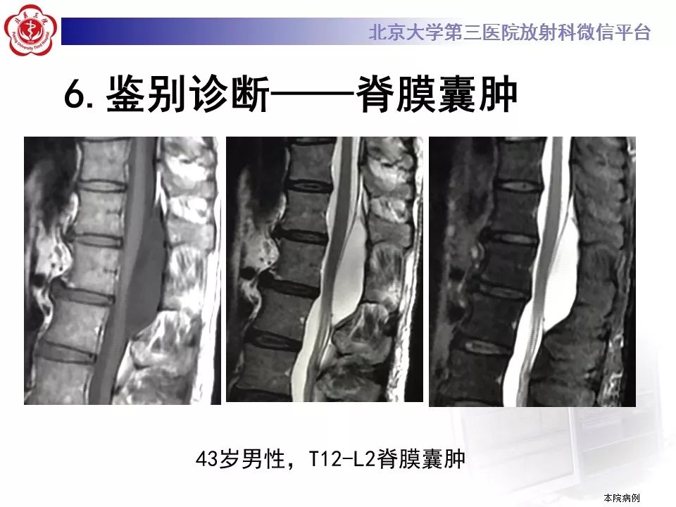 【病例】椎管内髓外硬膜下畸胎瘤1例