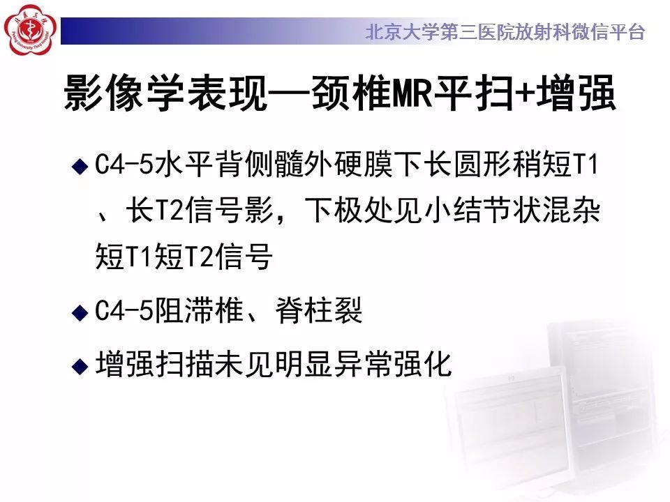 【病例】椎管内髓外硬膜下畸胎瘤1例