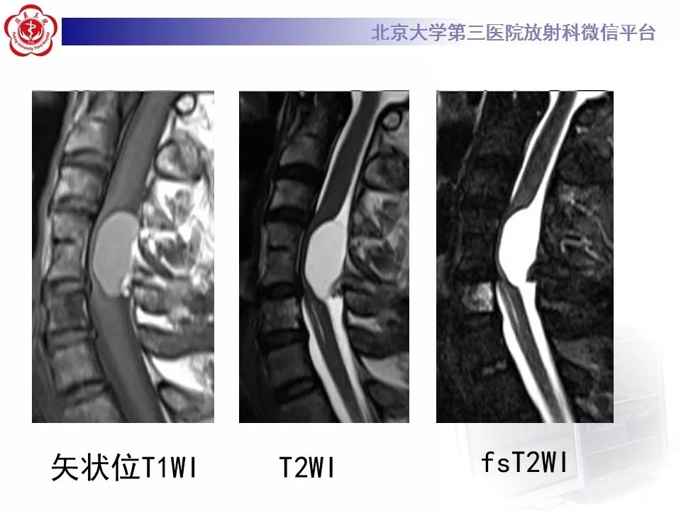 【病例】椎管内髓外硬膜下畸胎瘤1例