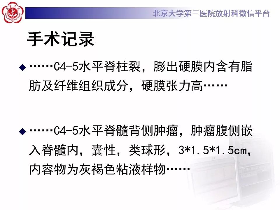 【病例】椎管内髓外硬膜下畸胎瘤1例