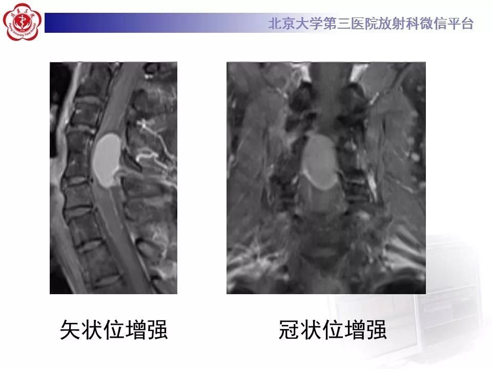 【病例】椎管内髓外硬膜下畸胎瘤1例
