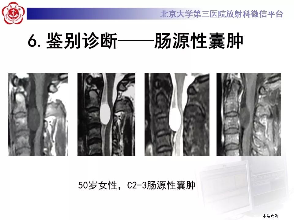 【病例】椎管内髓外硬膜下畸胎瘤1例
