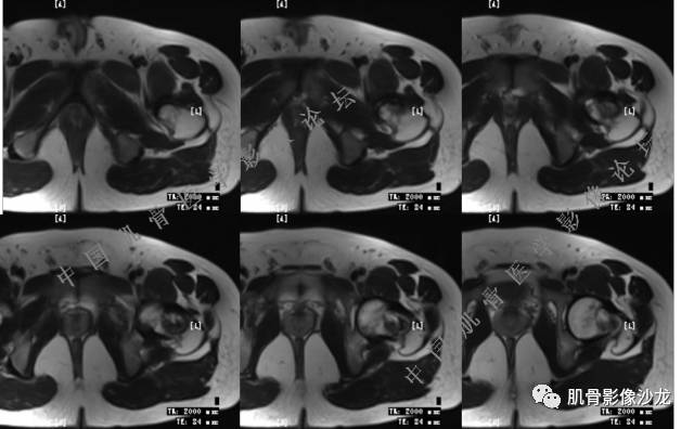 【病例】股骨近端占位性病变4例影像讨论