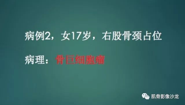 【病例】股骨近端占位性病变4例影像讨论
