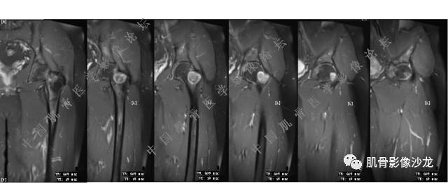 【病例】股骨近端占位性病变4例影像讨论