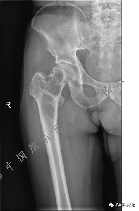 【病例】股骨近端占位性病变4例影像讨论