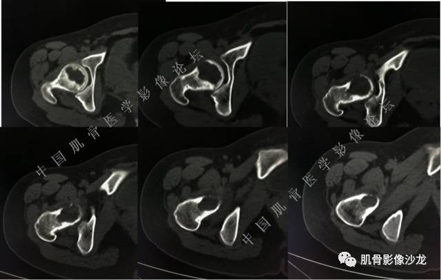 【病例】股骨近端占位性病变4例影像讨论