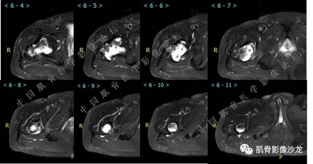 【病例】股骨近端占位性病变4例影像讨论