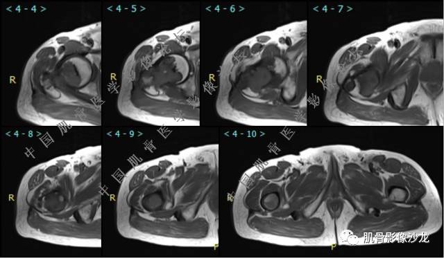 【病例】股骨近端占位性病变4例影像讨论