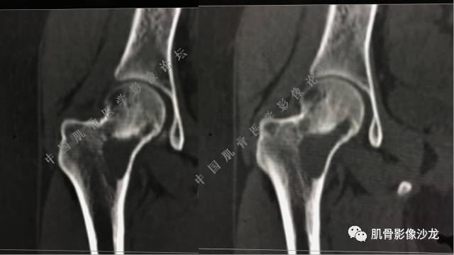 【病例】股骨近端占位性病变4例影像讨论