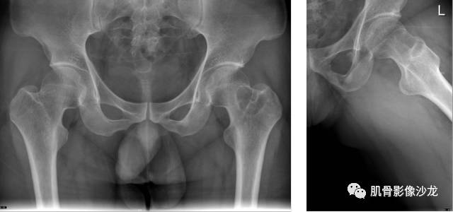 【病例】股骨近端占位性病变4例影像讨论