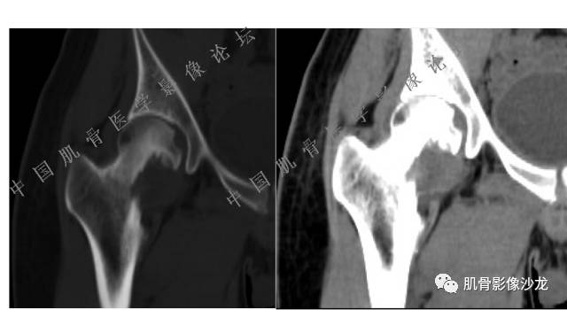【病例】股骨近端占位性病变4例影像讨论