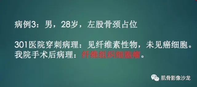 【病例】股骨近端占位性病变4例影像讨论