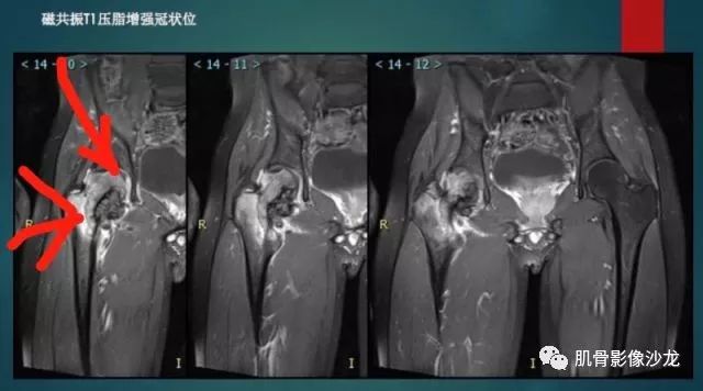 【病例】股骨近端占位性病变4例影像讨论