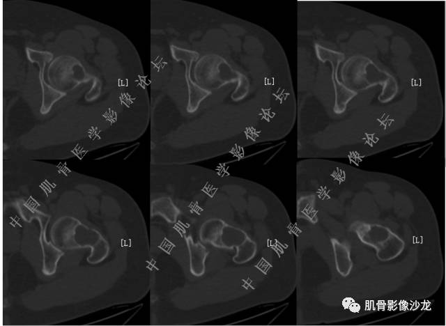 【病例】股骨近端占位性病变4例影像讨论