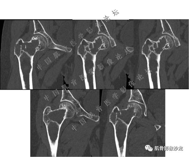 【病例】股骨近端占位性病变4例影像讨论