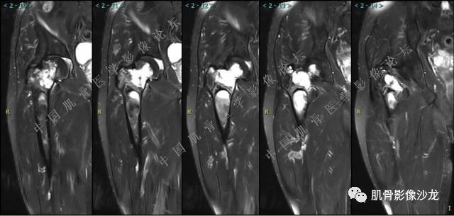 【病例】股骨近端占位性病变4例影像讨论