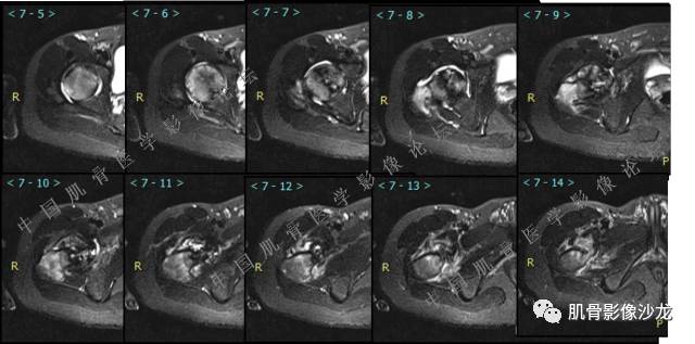 【病例】股骨近端占位性病变4例影像讨论