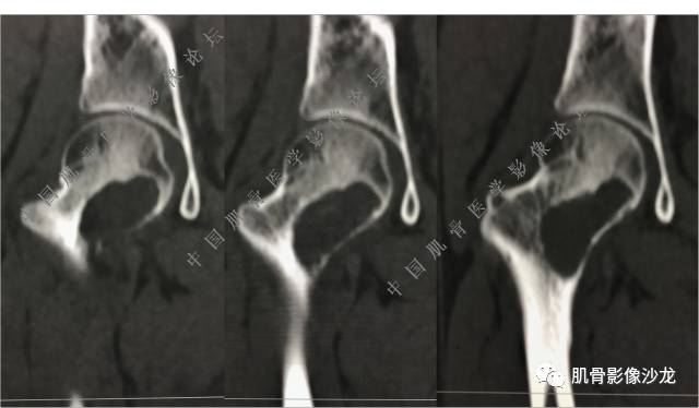 【病例】股骨近端占位性病变4例影像讨论