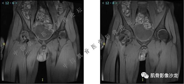 【病例】股骨近端占位性病变4例影像讨论