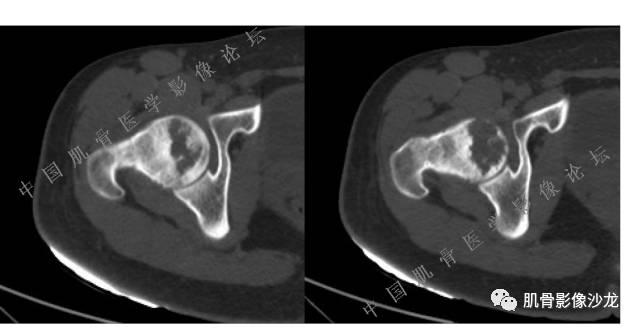 【病例】股骨近端占位性病变4例影像讨论