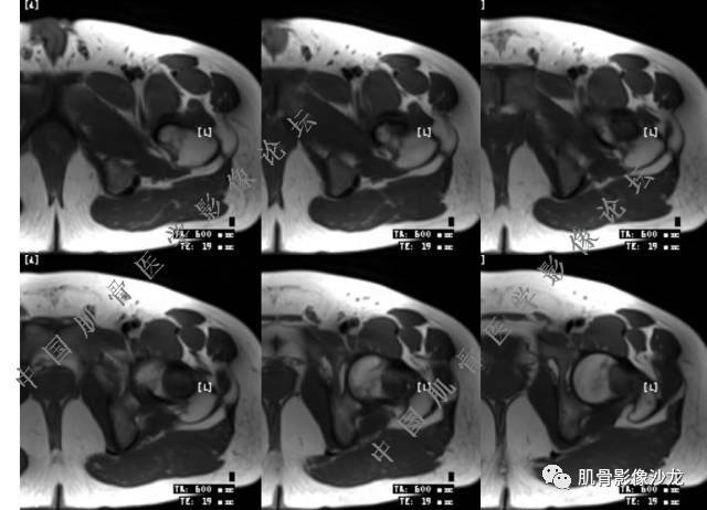 【病例】股骨近端占位性病变4例影像讨论