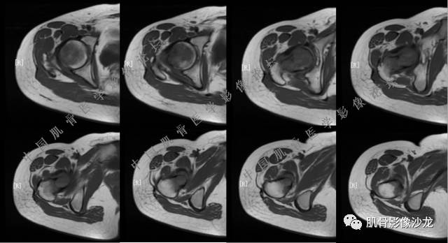 【病例】股骨近端占位性病变4例影像讨论