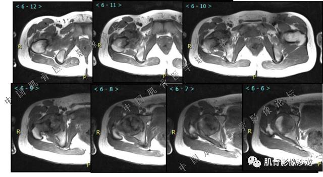 【病例】股骨近端占位性病变4例影像讨论
