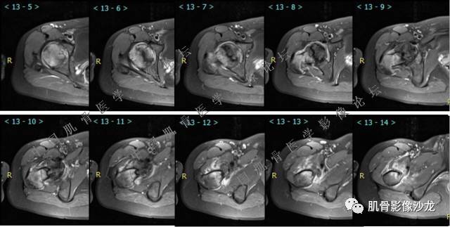 【病例】股骨近端占位性病变4例影像讨论
