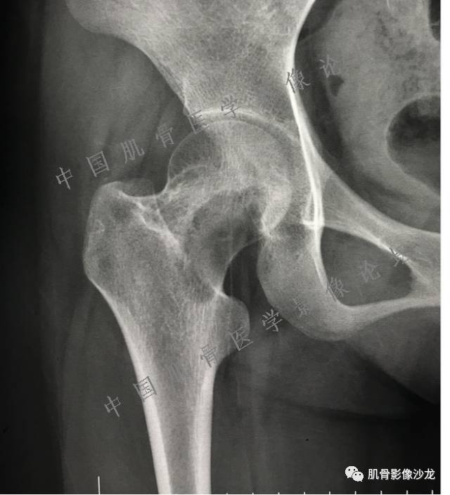 【病例】股骨近端占位性病变4例影像讨论
