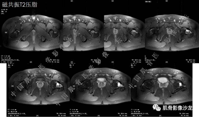 【病例】股骨近端占位性病变4例影像讨论