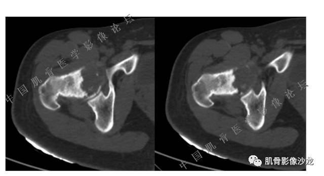 【病例】股骨近端占位性病变4例影像讨论