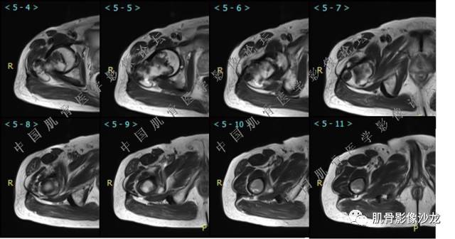 【病例】股骨近端占位性病变4例影像讨论